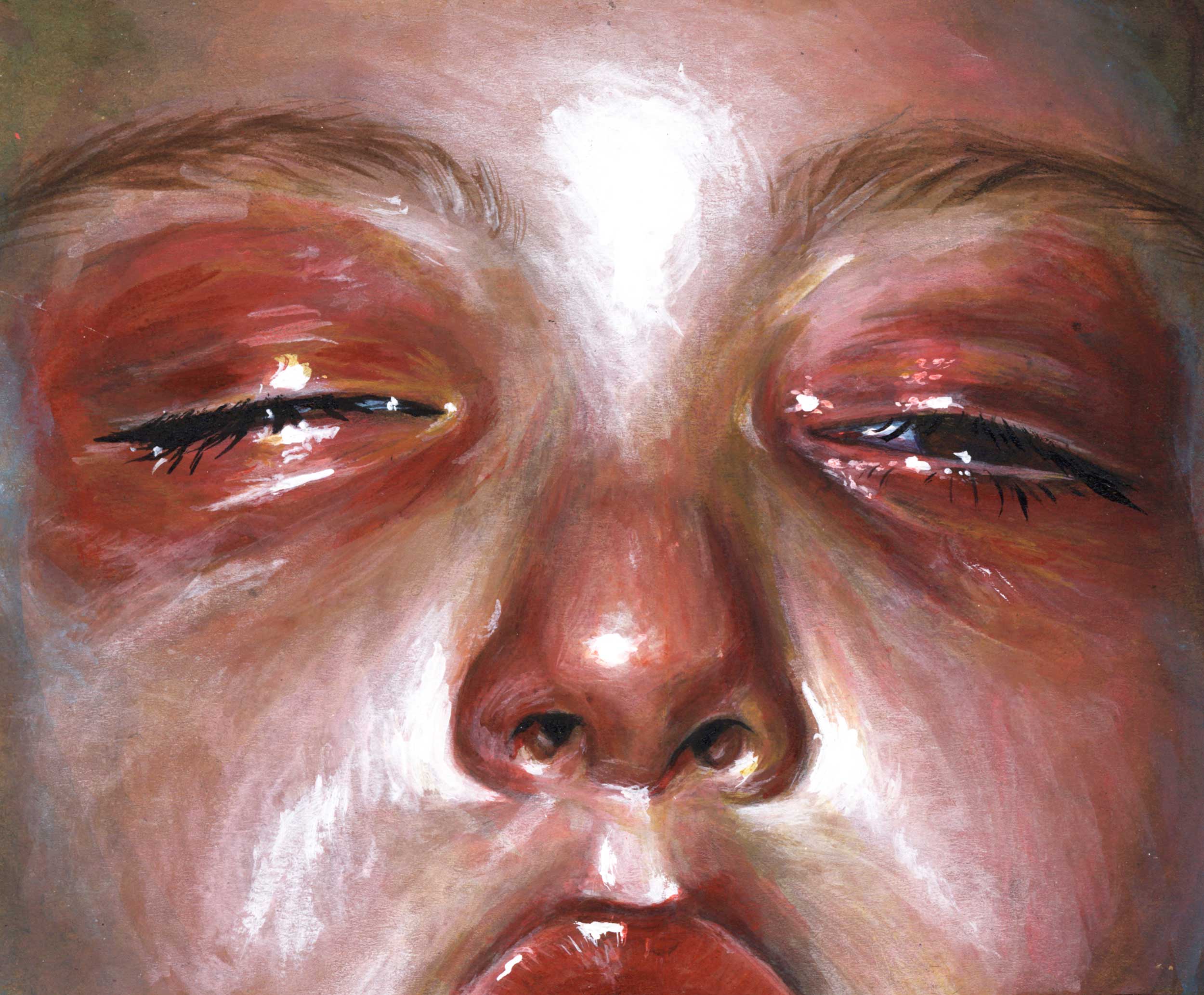 conjunctivitis, acrylic